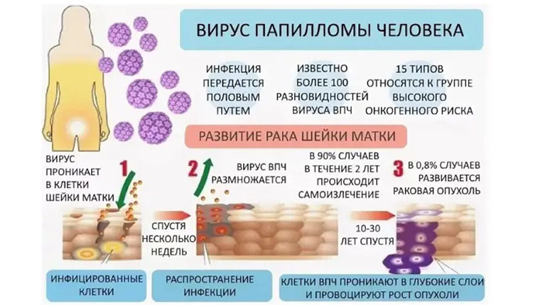 Остановим рак вакциной.  Всё о вирусе папилломы человека