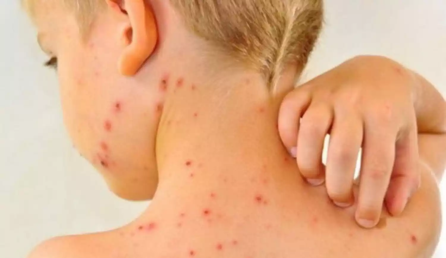 За последнюю неделю заболеваемость корью снизилась в 1,4 раза в Жамбылской области